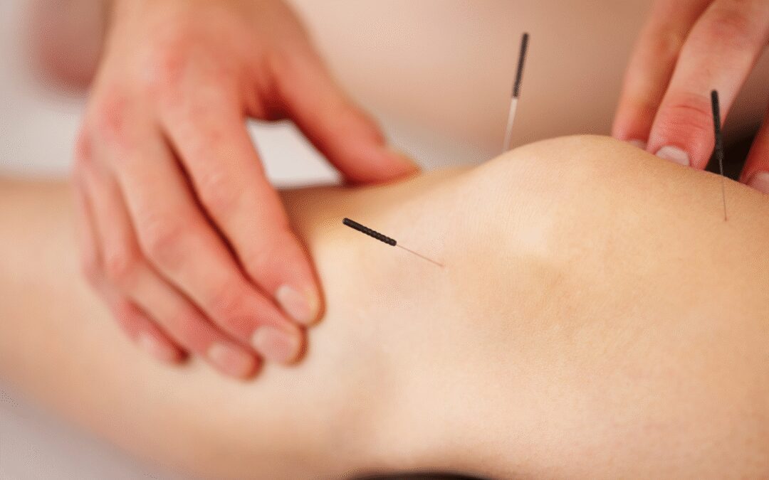 Rodillas sin dolor: La acupuntura sanando tendones, ligamentos y meniscos